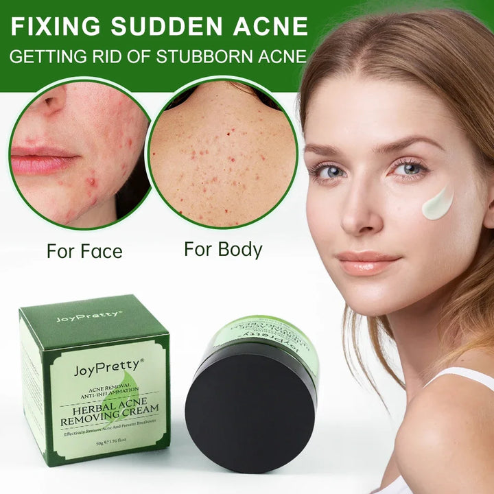 Herbal Acne Face Cream - Oil Control & Pimple Mark Removal