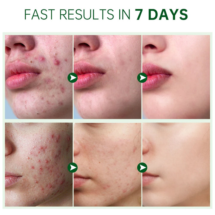 Herbal Acne Face Cream - Oil Control & Pimple Mark Removal